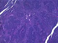 Hodgkin lymphoma, nodular lymphocyte predominant (low-power view): Notice the nodular architecture and the areas of "mottling" (H&E).