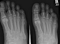 X-ray of foot