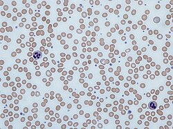 Microsopic view with Giemsa staining of a blood smear with abnormally small and translucent red blood cells