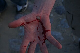 An open bleeding wound on the palm caused by falling from a skateboard