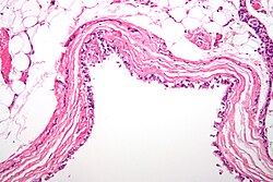 Histological micrographic image of a bronchogenic cyst of the mediastinum. Sample has been stained with hematoxylin and eosin to improve contrast.