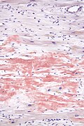 Micrograph showing amyloid deposition (red fluffy material) in the heart (cardiac amyloidosis). Congo red stain.
