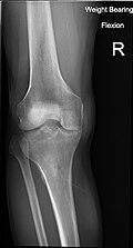 Knee X-ray (weight bearing, flexion)