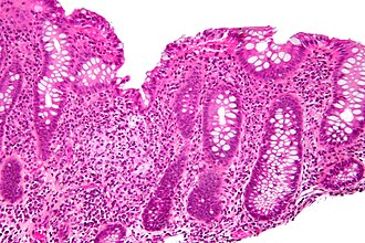 Focal cryptitis and a granuloma. H&E stain.