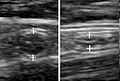 A normal appendix without and with compression. Absence of compressibility indicates appendicitis.[59]