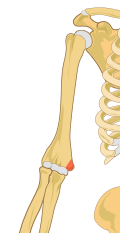 Right medial epicondyle colored in red.