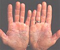 Psoriasis of the palms