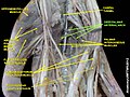 Deep palmar arterial arch