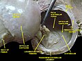 Hip joint. Lateral view. Fat in acetabular fossa.