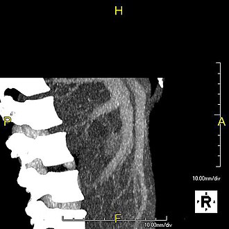 Lateral MIP view in the same patient as previous image