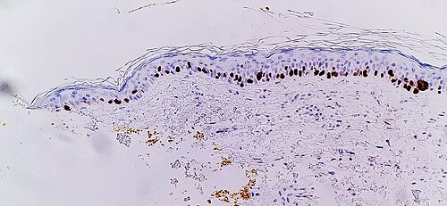 SOX10 immunohistochemistry facilitates showing lentigo maligna, as an increased number of melanocytes along stratum basale and nuclear pleomorphism. The changes are continuous with the resection margin (inked in yellow, at left), conferring a diagnosis of a not radically removed lentigo maligna.