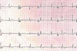 RBBB
