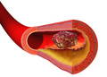 Illustration depicting thrombus formation over arterial plaque.