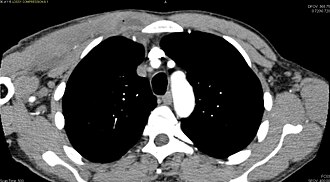 CT with IV contrast showing enlargement and heterogeneous hypodensity in the right pectoralis major muscle. A focal abscess collection with gas within it is present medially. There are enlarged axillary lymph nodes and some extension into the right hemithorax. Note the soft tissue and phlegmon surrounding the right internal mammary artery and vein. The patient was HIV+ and the pyomyositis is believed to be due to direct inoculation of the muscle related to parenteral drug abuse. The patient admitted to being a "pocket shooter"