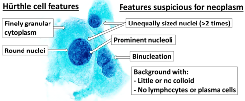 Cytopathology suspicious for Hürthle cell neoplasm (Bethesda category IV, rather than Hürthle cell hyperplasia), Pap stain.[13]