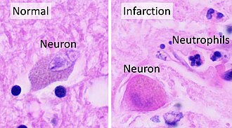 In stroke, they are beginning to infiltrate the infarcted brain after 6 to 8 hours.[70]