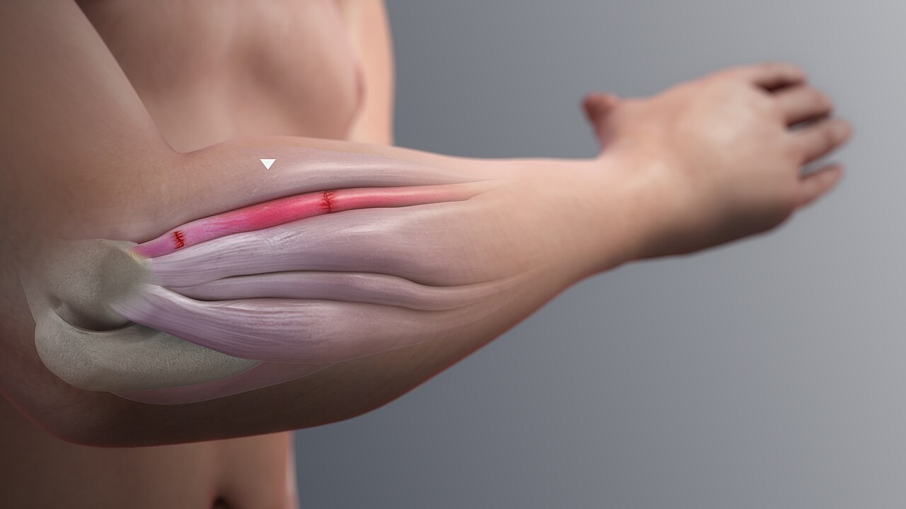 Inflammation of a forearm extensor muscle.jpg