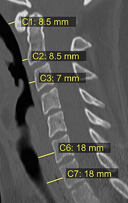 CT scan with upper limits of the thickness of the prevertebral space at different levels[12]
