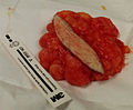 This lipoma was removed from the thigh of a 39-year-old male patient. It measured about 10 cm in diameter at the time of removal. In the center is a section of skin that was removed with the lipoma.
