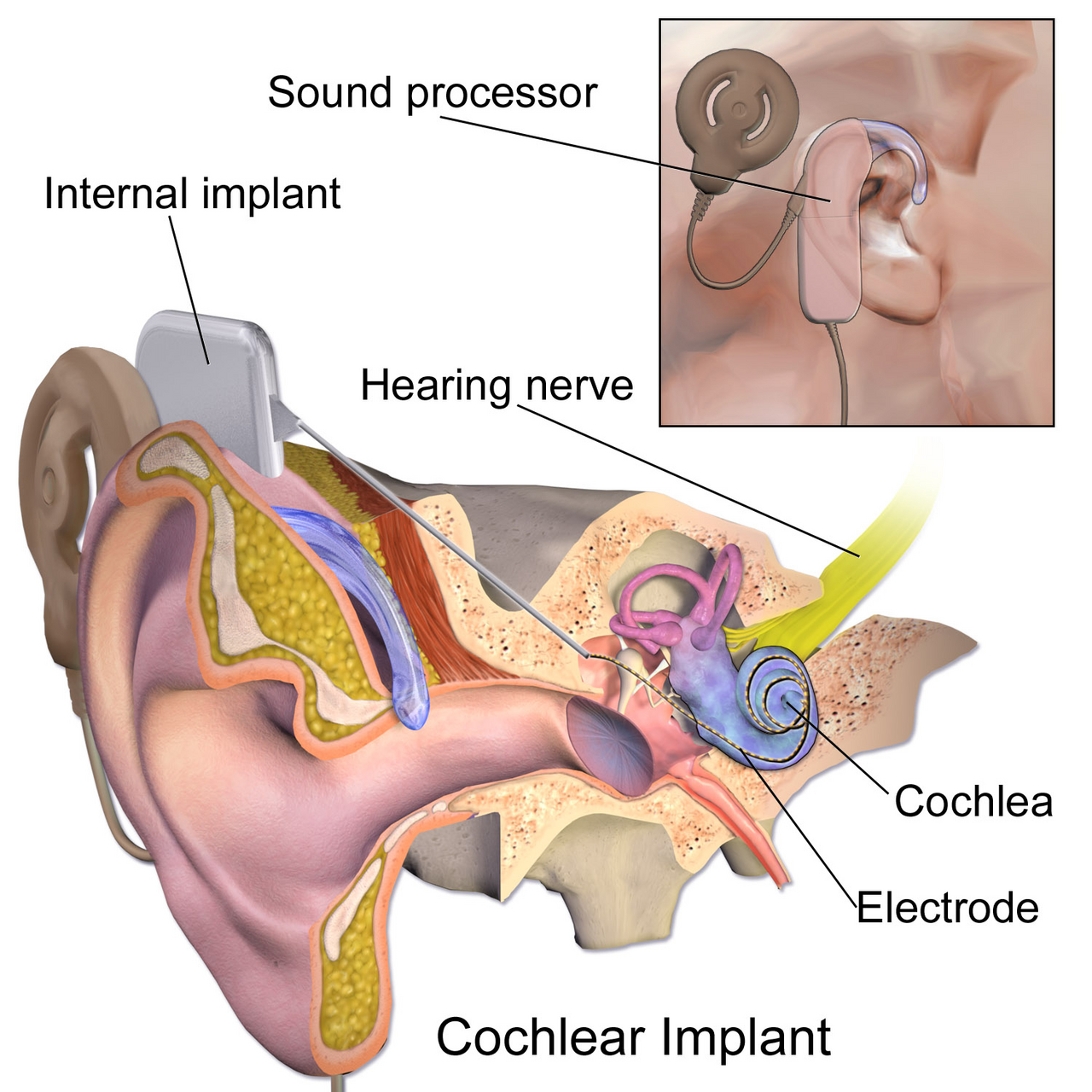 Blausen 0244 CochlearImplant 01.png